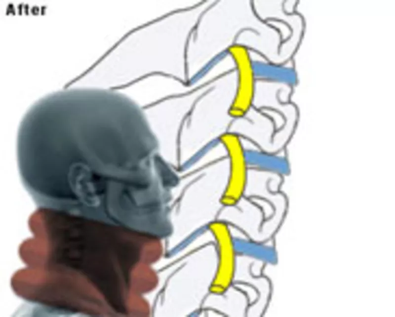Лечебный воротник для шеи…. 8