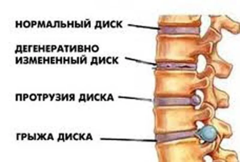 Кровать для вытяжки позвоночника .