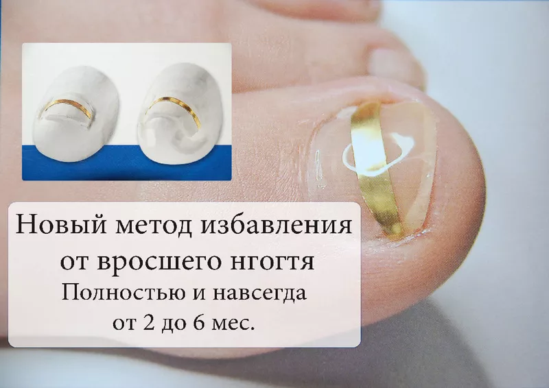 Как избавиться от вросшего ногтя в Алматы?  2