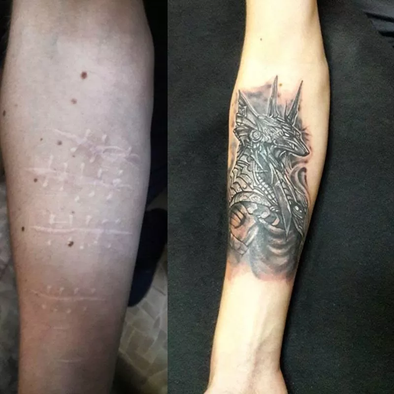 Лазерное выведение татуировок 2
