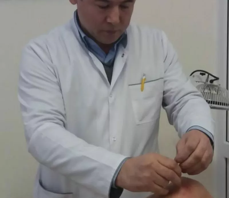 Иглорефлексотерапия в Алматы 3